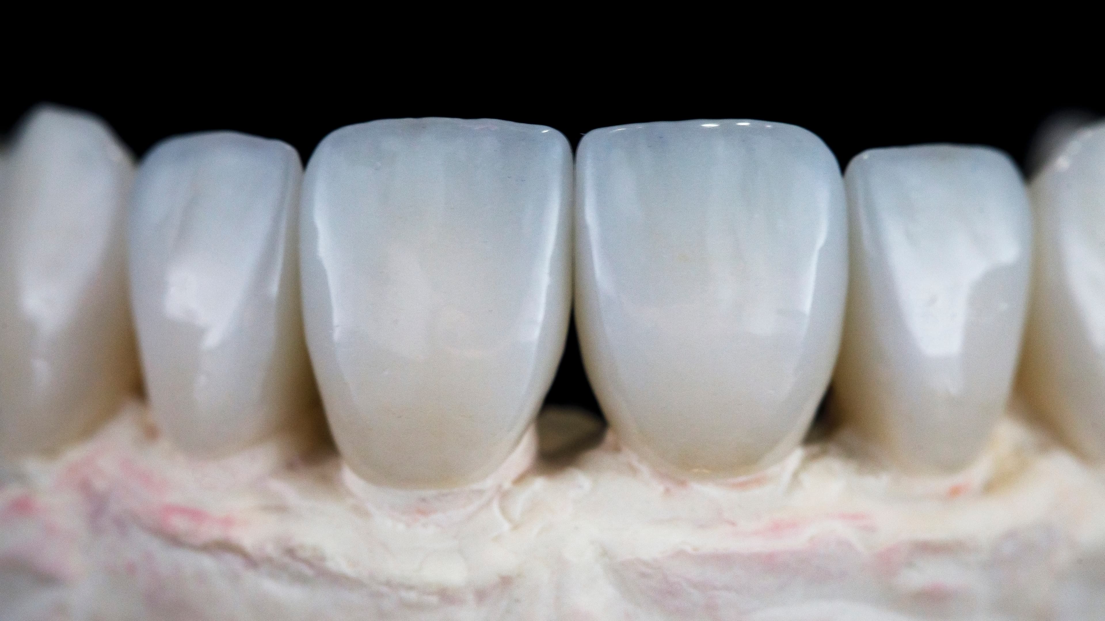 Su-veneer — laminate macro on gypsum model