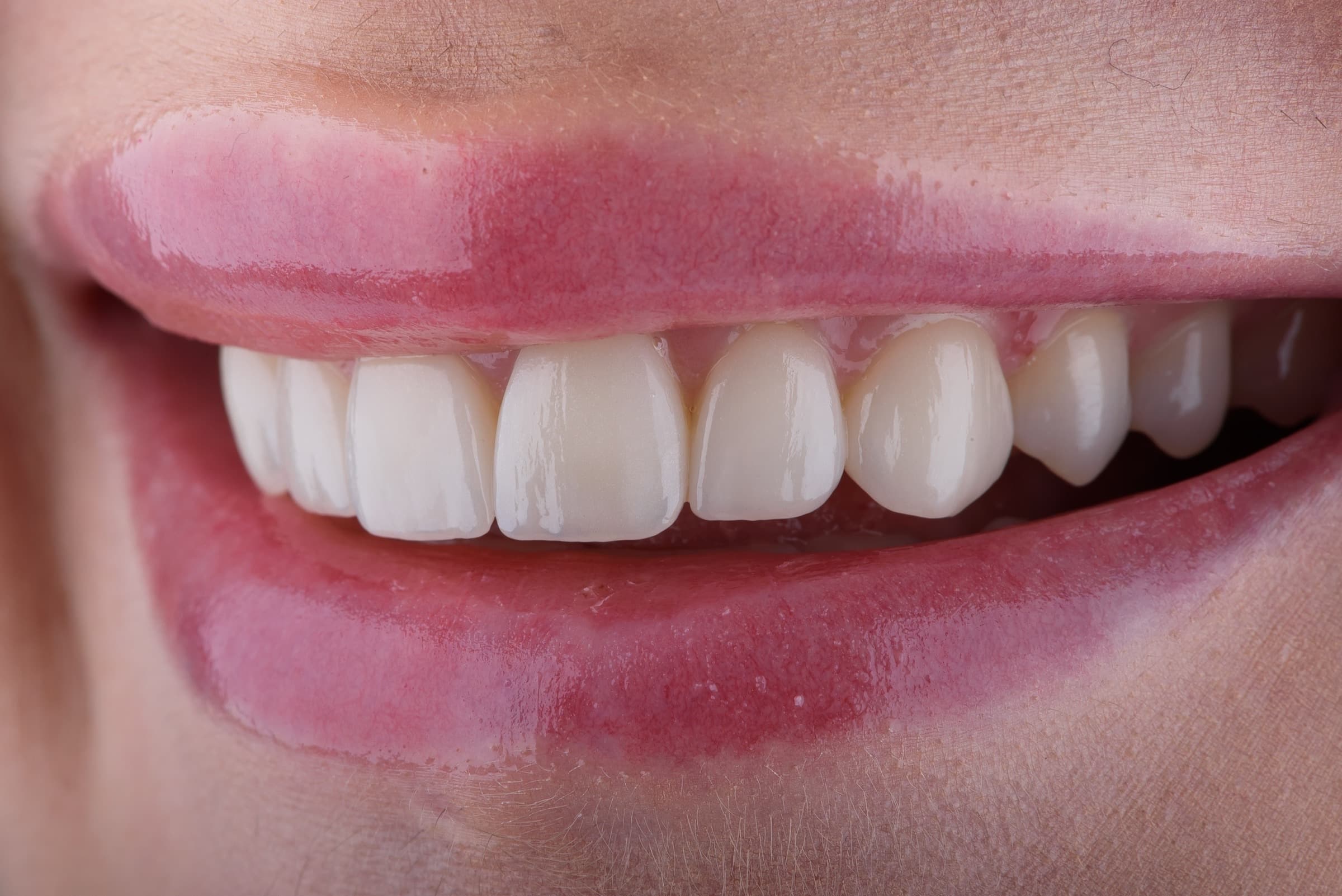 A natural Su-Veneer smile, close up
