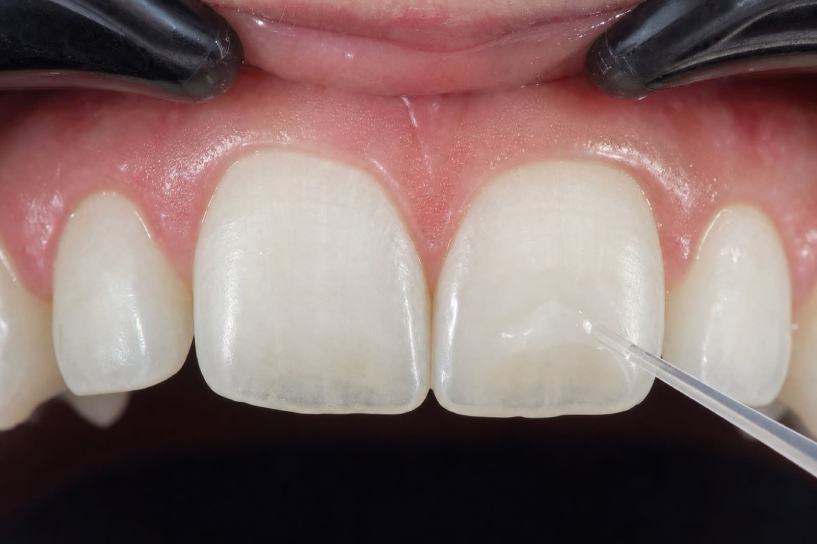 White spot · ICON resin — resin infiltrating a white spot