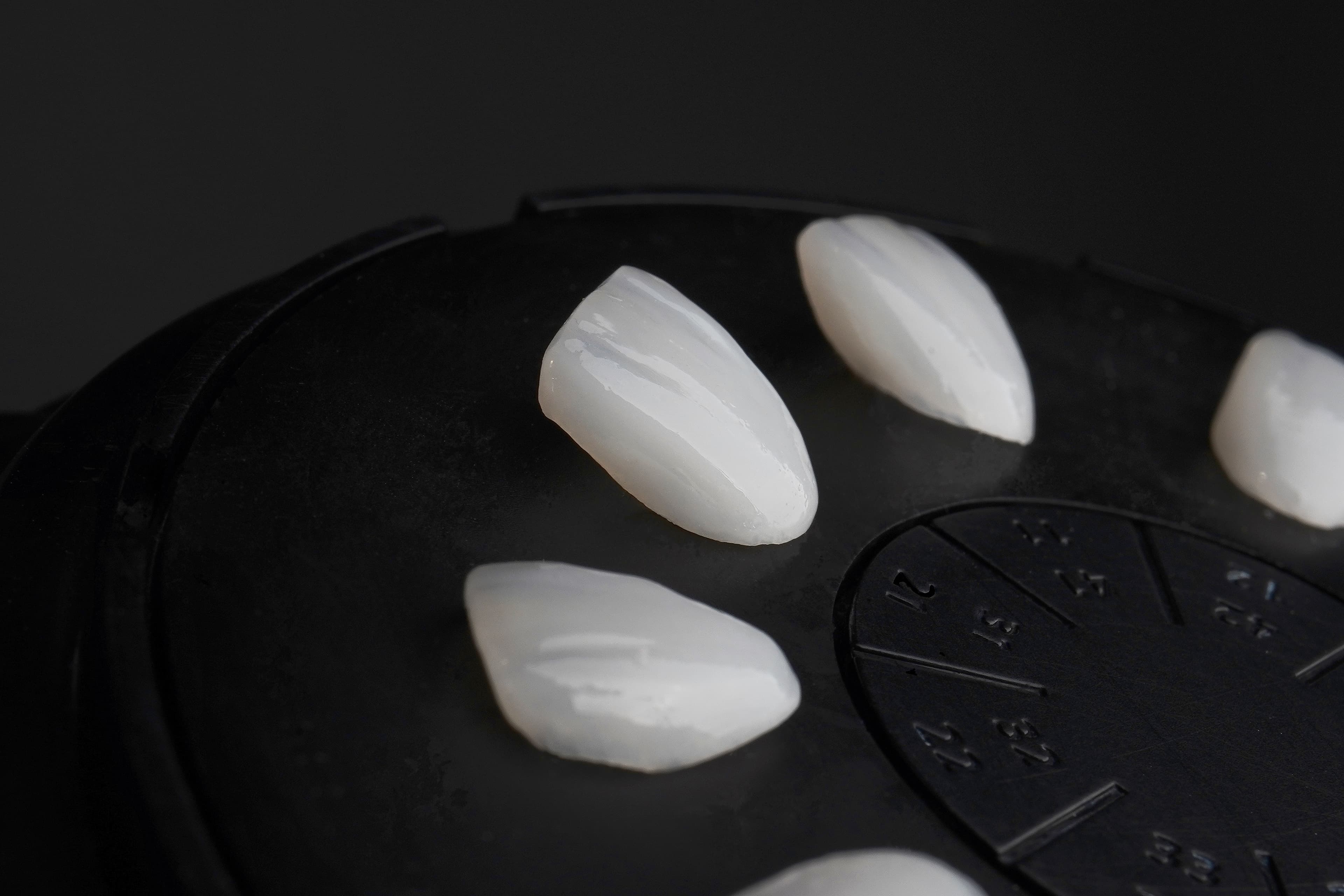 Do I Really Need Veneers? Alternatives to Consider Before Getting Veneers
